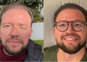 Clínica se pronuncia após jornalista Felipe Pereira relatar complicações em aplicação de botox em Teresina